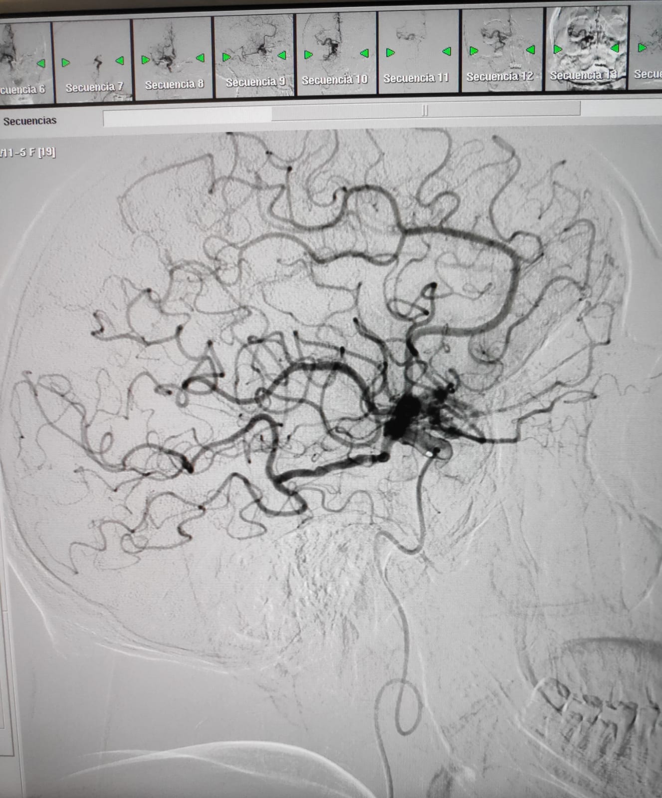 Una imatge del cervell d'un pacient que ha tingut un ictus isquèmi, després del tractament i de recuperar la circulació