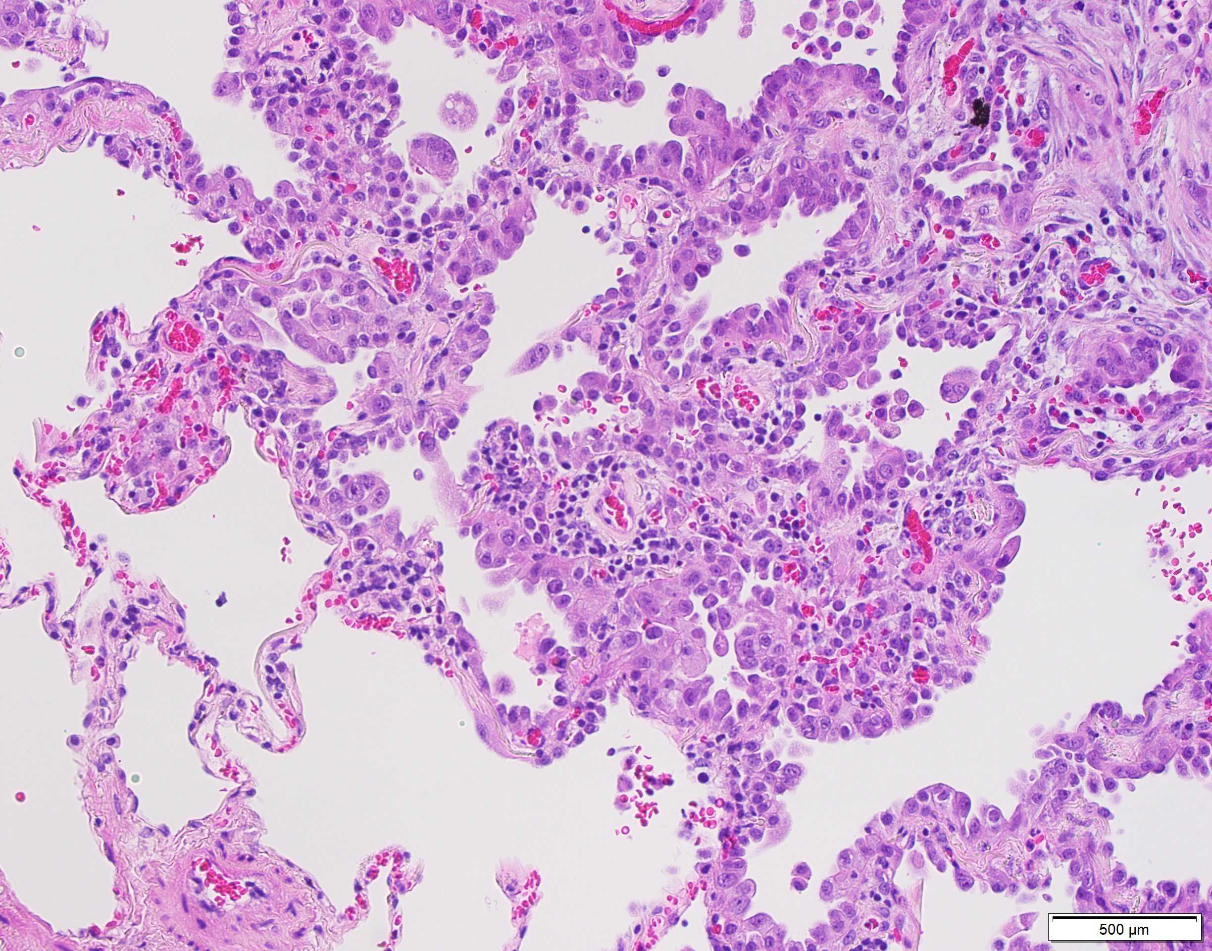 Imatge microscòpica de cel·lules cancerígenes de pulmó
