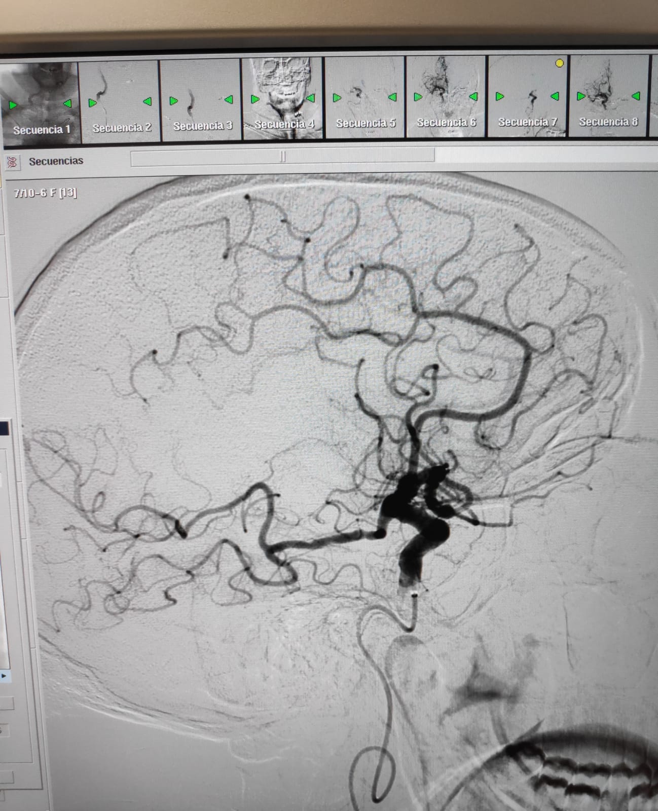 Una imatge del cervell d'un pacient que ha tingut un ictus isquèmic.