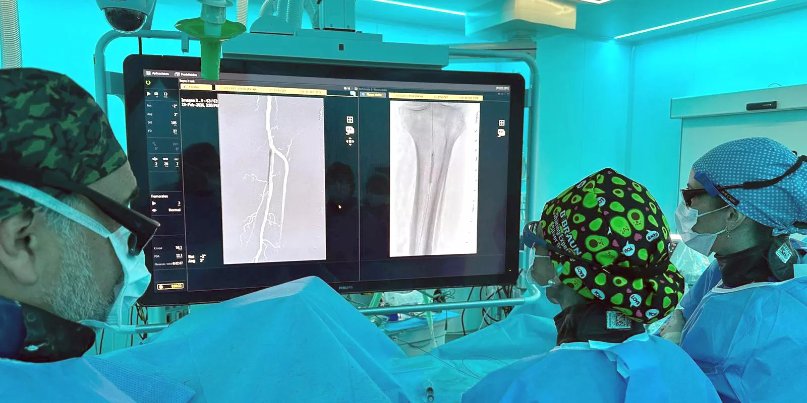 Profesisonals del Sevei d'Angiologia i Cirurgia Vascular del Trueta durant la intervenció d'implant del ispositiu reabsorbible en artèries distals de la cama per sota del genoll.