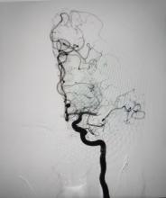 Imatge radiològica d'un cervell d'un pacient que ha patit un ictus isquèmic.